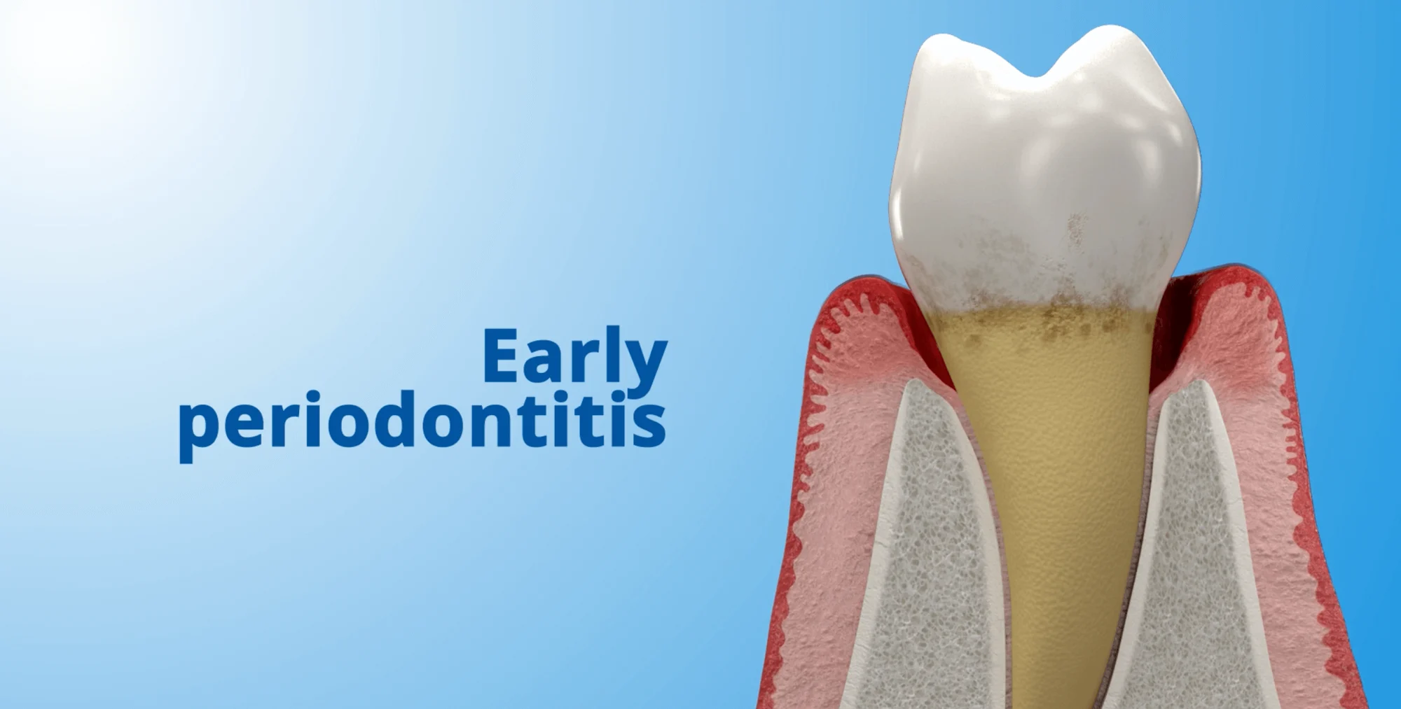 Early Periodontitis