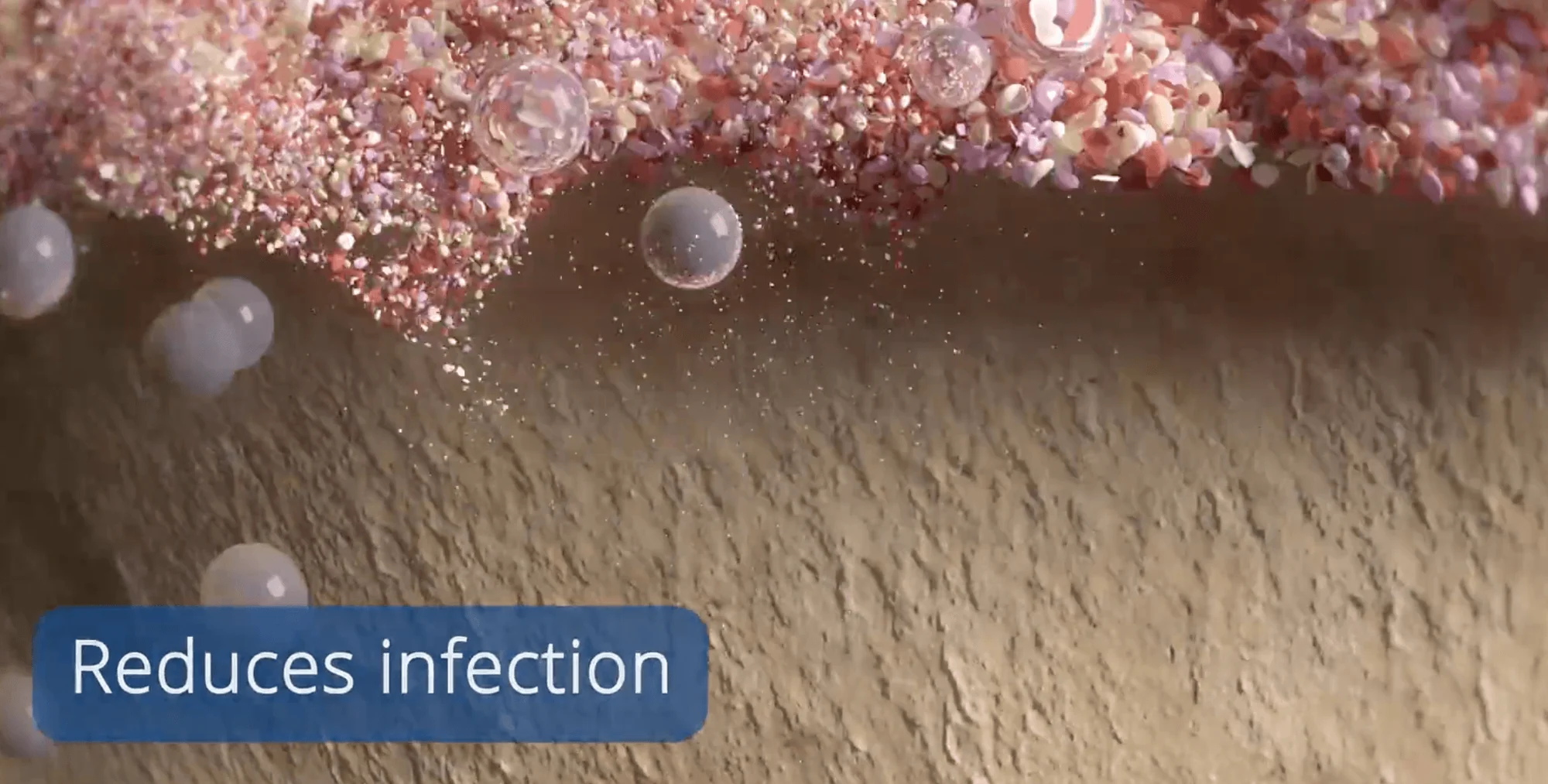 Laser Perio Reduces Infection 2