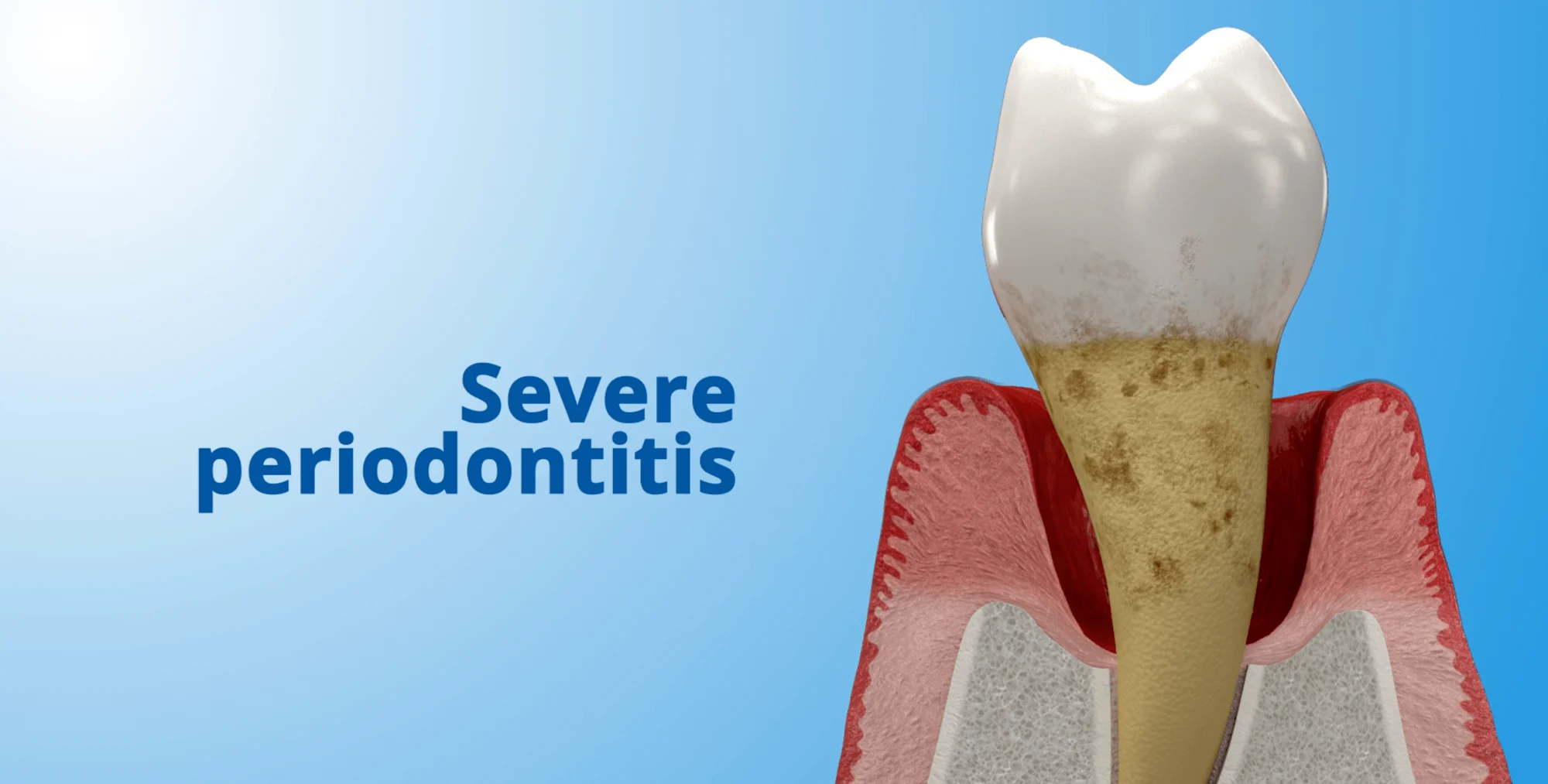 Severe Periodontitis 3